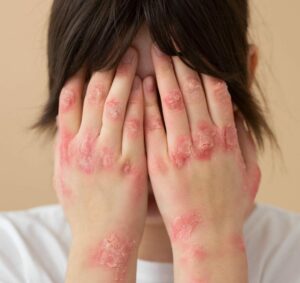 Lúpus: mais de 90% dos pacientes usam esteroides para tratar a doença